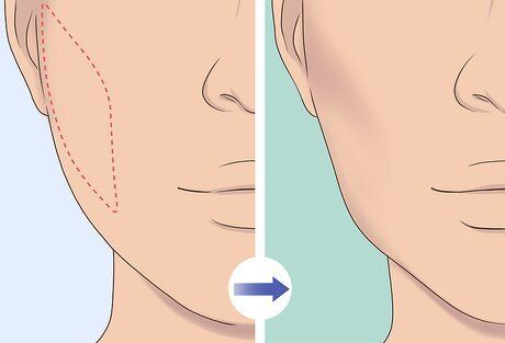 Cheekbone Enhancement for Flat or Underdefined Cheekbones