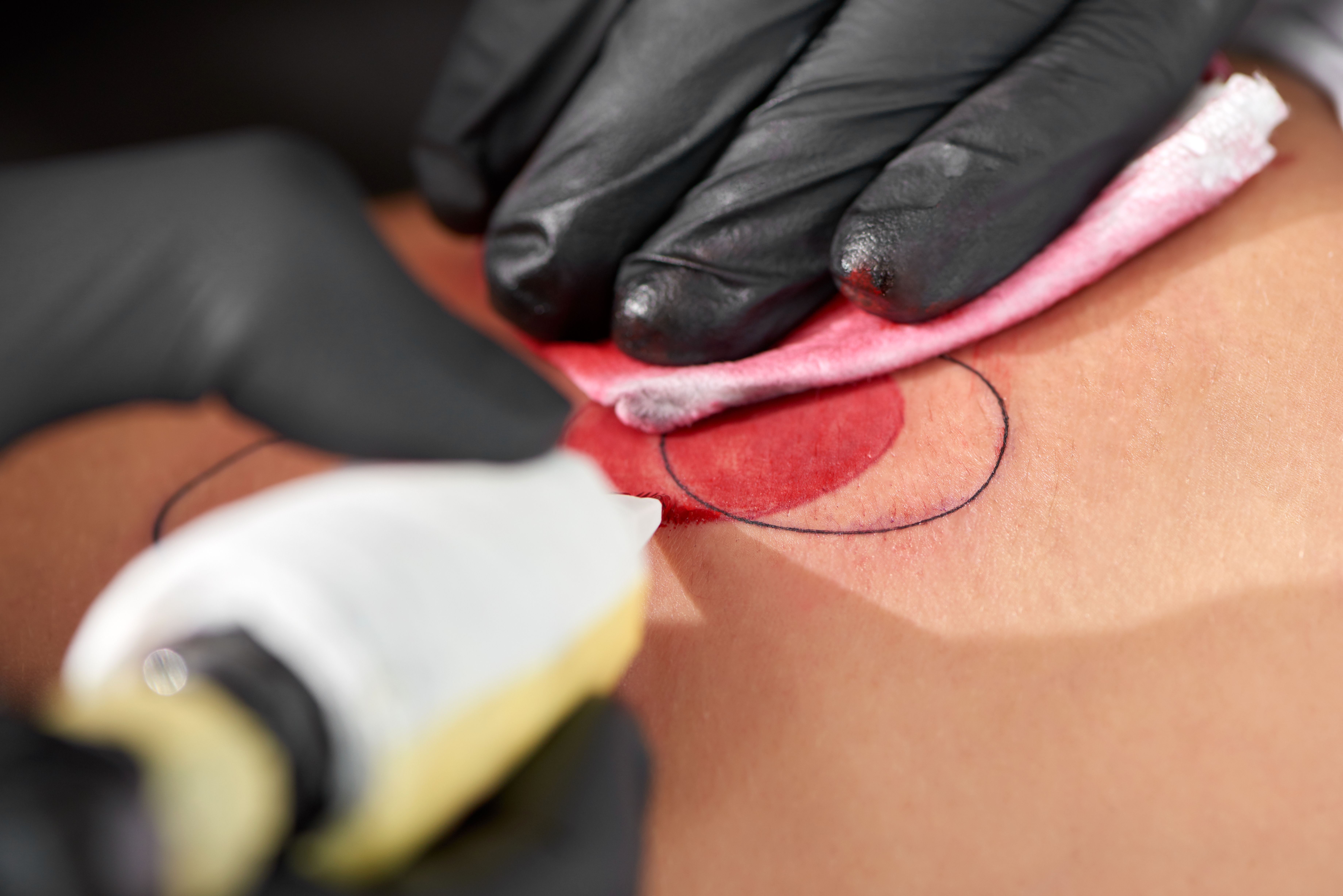 Tattoo Removal 