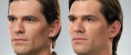 Cheekbone Enhancement for Facial Contouring