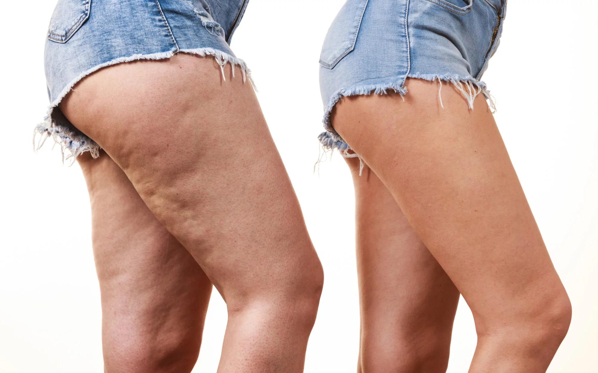 Cellulite Reduction
