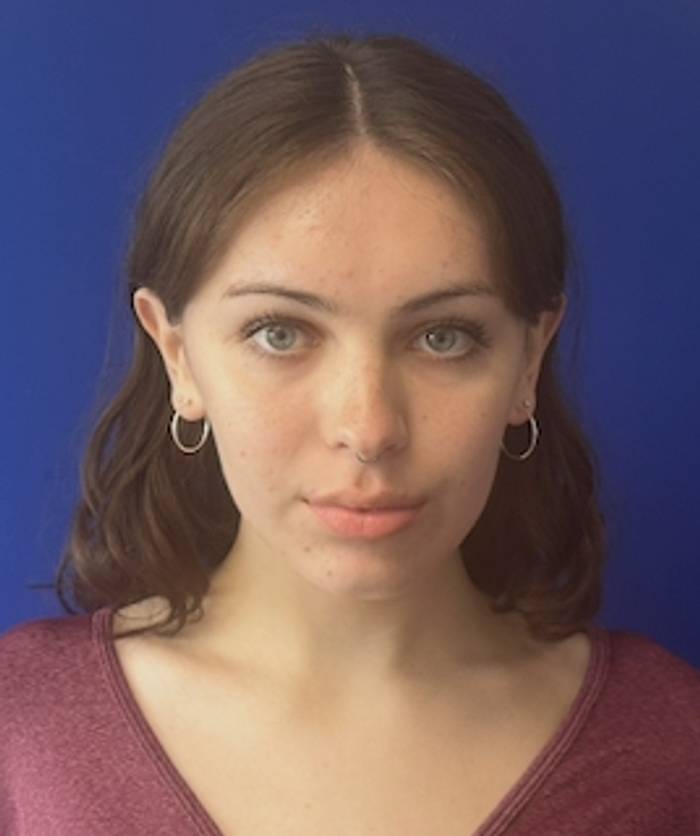Before rhinoplasty with facial feminization surgery, frontal view. 20s Transgender Female - 1 year postoperative result for facial feminization surgery.