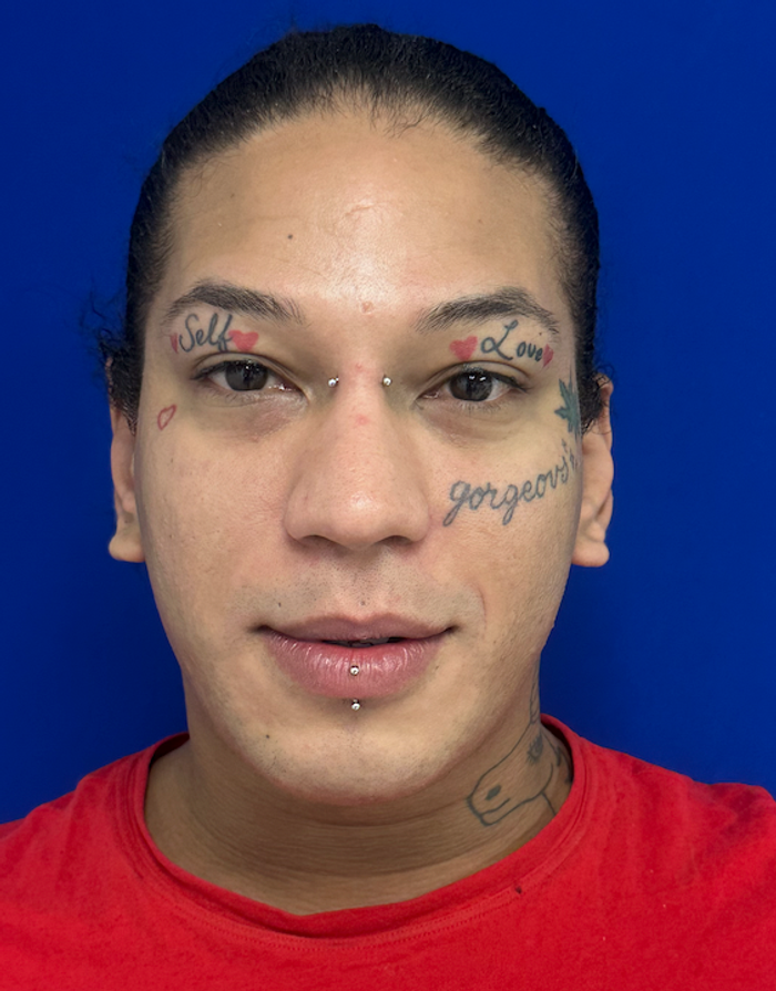Before rhinoplasty with facial feminization surgery, frontal view. 20s Transgender Female - 3 months postoperative result for facial feminization surgery. 1 month postoperative result upper lip lift