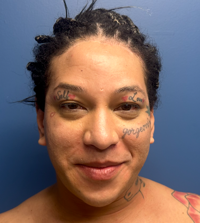 After rhinoplasty with facial feminization surgery, frontal view. 20s Transgender Female - 3 months postoperative result for facial feminization surgery. 1 month postoperative result upper lip lift