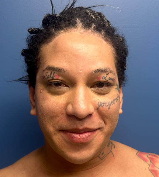 After rhinoplasty with facial feminization surgery, frontal view. 20s Transgender Female - 3 months postoperative result for facial feminization surgery. 1 month postoperative result upper lip lift