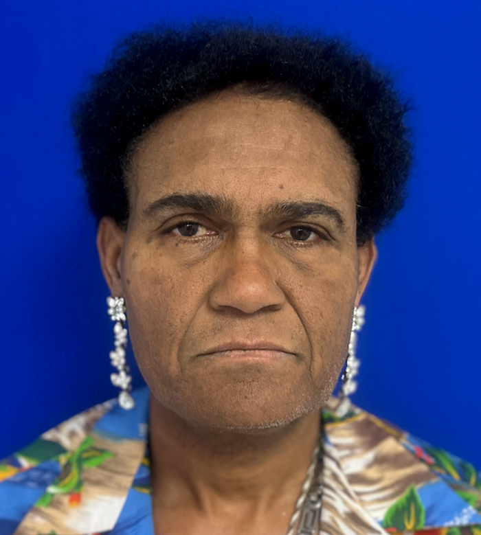 Before rhinoplasty with facial feminization surgery, frontal view. 50s Transgender Female - 1 month postoperative result for facial feminization surgery.