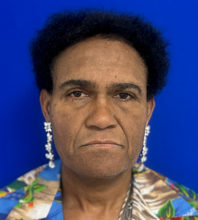 Before rhinoplasty with facial feminization surgery, frontal view. 50s Transgender Female - 1 month postoperative result for facial feminization surgery.