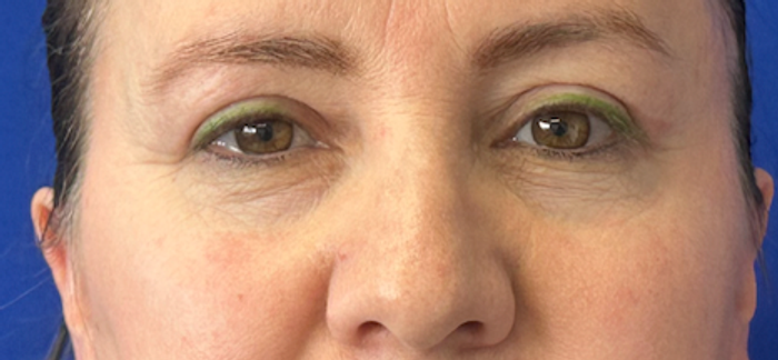 After blepharoplasty, frontal view. 40s Female. Blepharoplasty — 2.5-month postoperative result.