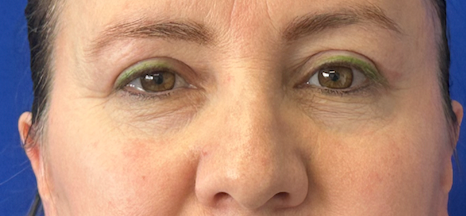 After blepharoplasty, frontal view. 40s Female. Blepharoplasty — 2.5-month postoperative result.
