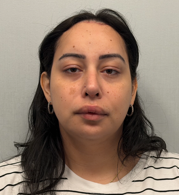 After rhinoplasty with facial feminization surgery, frontal view. 20s Transgender Female - 6 weeks post-operative result for facial feminization surgery