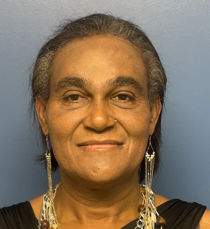 After rhinoplasty with facial feminization surgery, frontal view. 50s Transgender Female - 1 month postoperative result for facial feminization surgery.