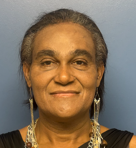 After rhinoplasty with facial feminization surgery, frontal view. 50s Transgender Female - 1 month postoperative result for facial feminization surgery.