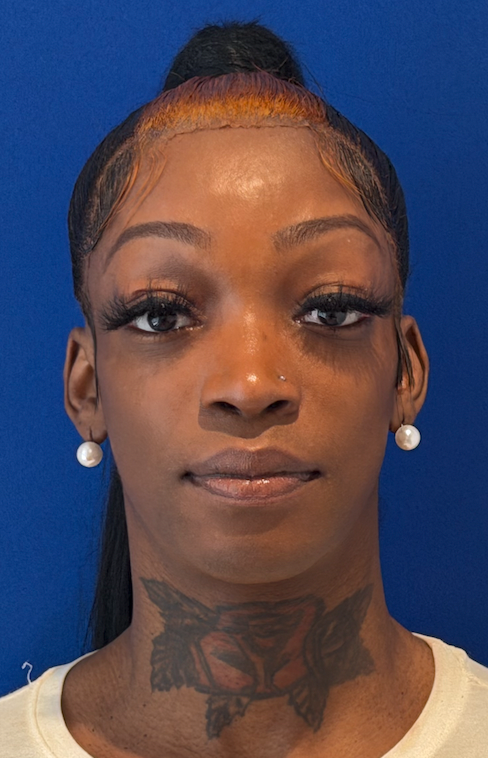 After facial feminization surgery, frontal view. 30s Transgender Female - 2.5 month postoperative result for facial feminization surgery