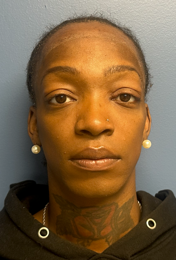 Before facial feminization surgery, frontal view. 30s Transgender Female - 2.5 month postoperative result for facial feminization surgery