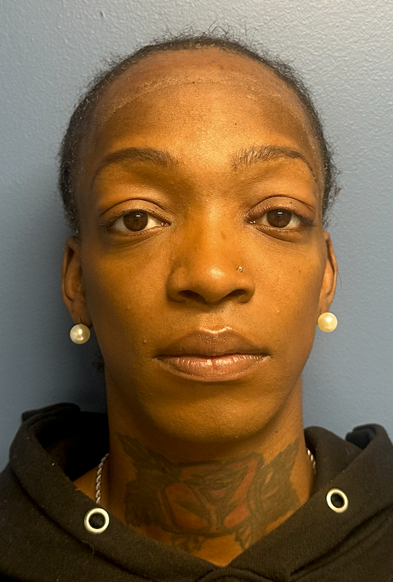 Before facial feminization surgery, frontal view. 30s Transgender Female - 2.5 month postoperative result for facial feminization surgery