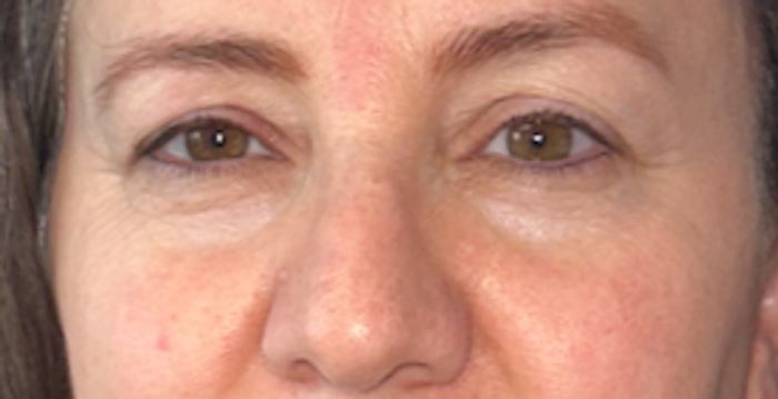 Before blepharoplasty, frontal view. 40s Female. Blepharoplasty — 2.5-month postoperative result.