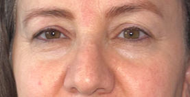 Before blepharoplasty, frontal view. 40s Female. Blepharoplasty — 2.5-month postoperative result.