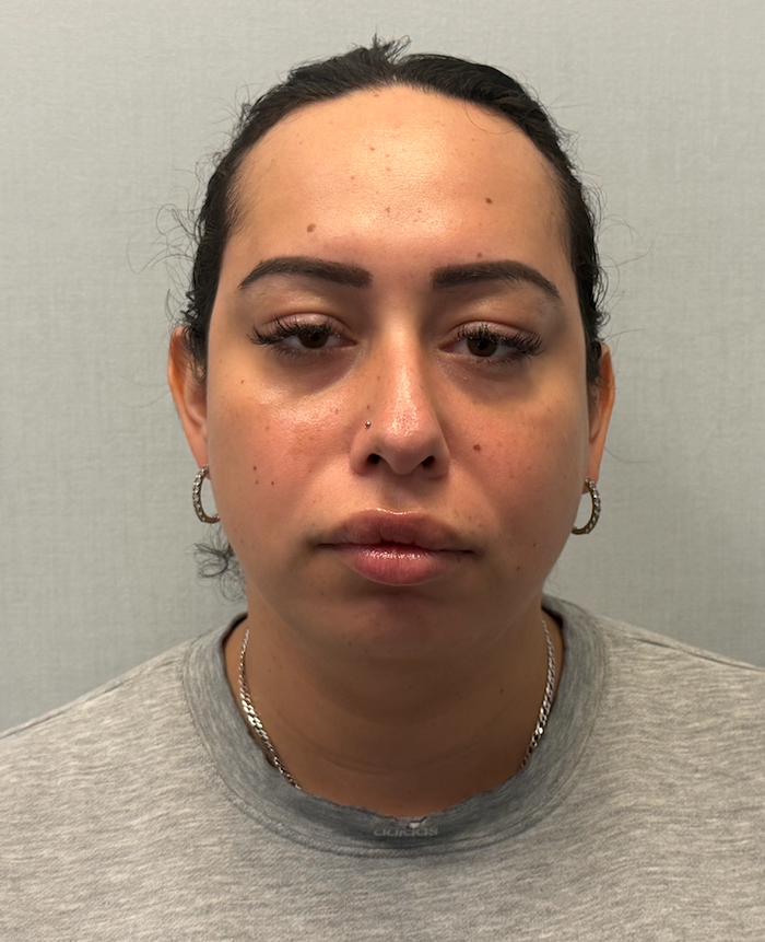 Before rhinoplasty with facial feminization surgery, frontal view. 20s Transgender Female - 6 weeks post-operative result for facial feminization surgery