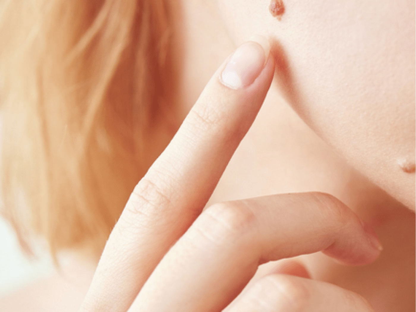 Moles in a woman's face