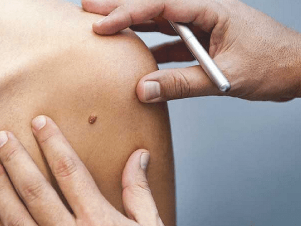 Mole Removal in Japan | Step-by-Step Guide
