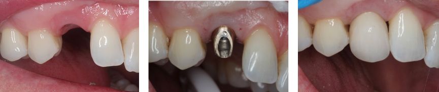 dental implant process