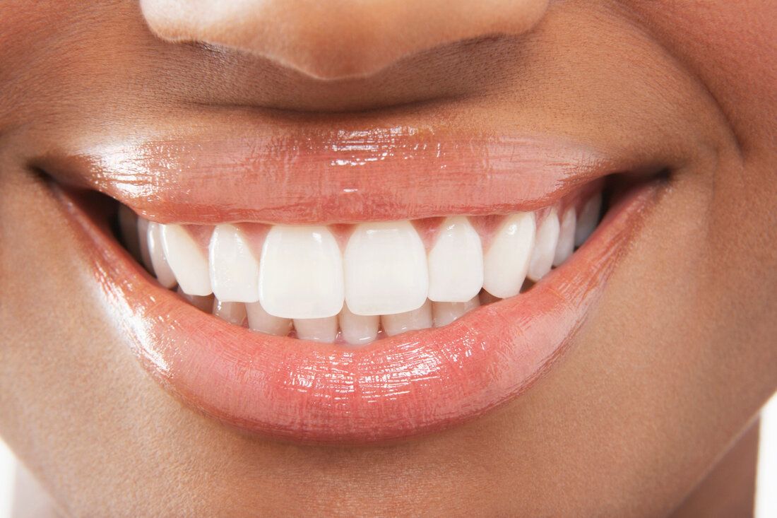 Closeup of woman’s beautiful white teeth in San Francisco