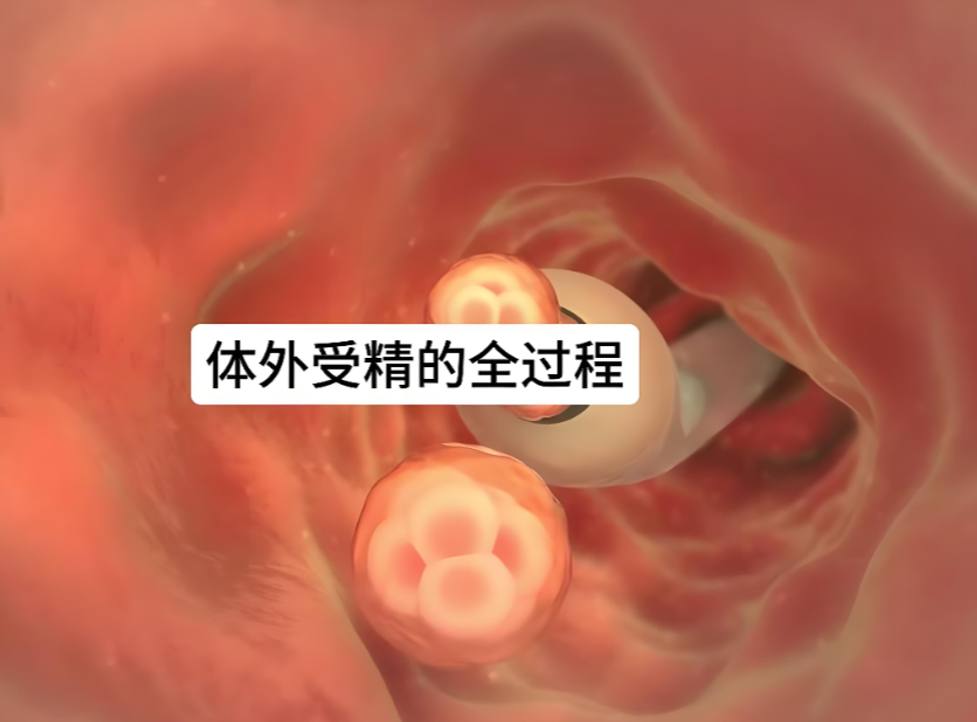 体外受精胚胎移植