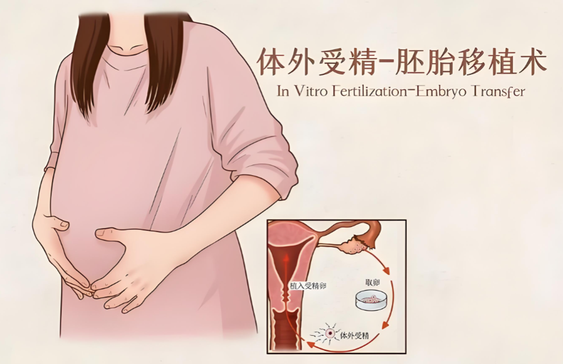 哪类夫妇需要IVF体外受精？