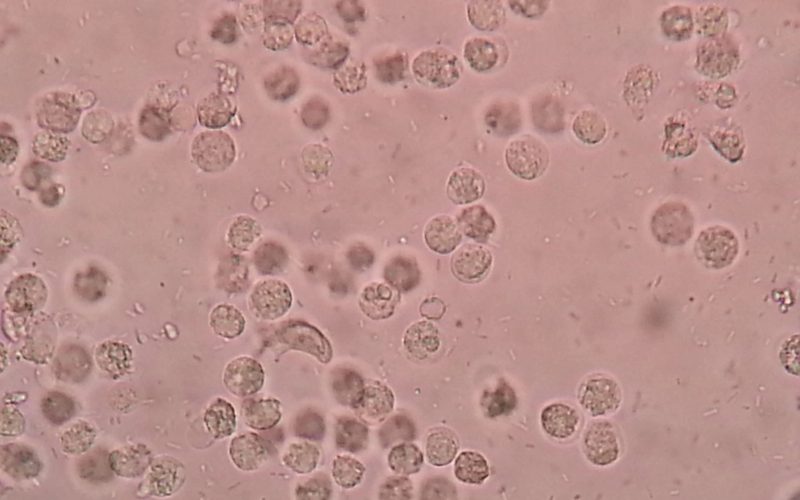 Why UTIs in Elderly Often Go Unnoticed: Warning Signs You Can't Miss