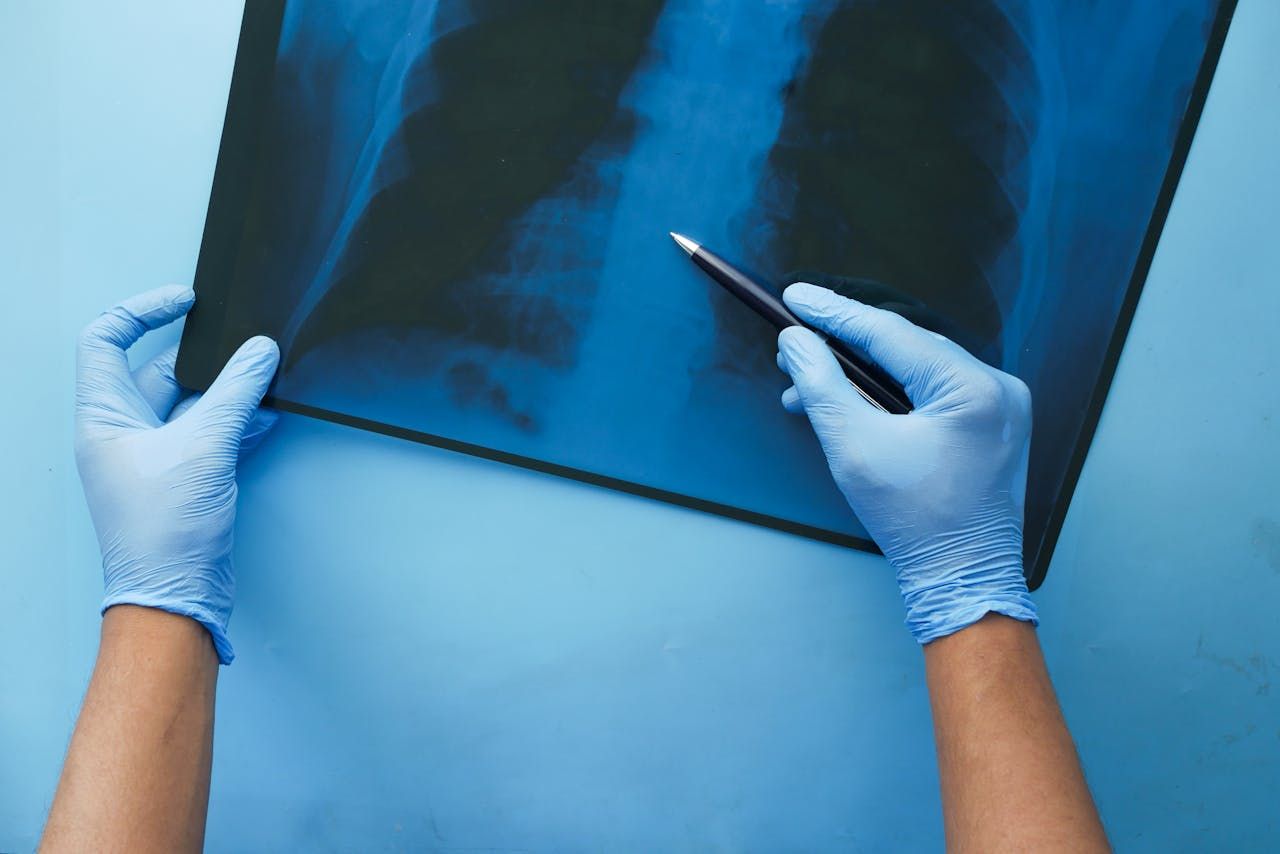 How Serious Is Fluid in the Lungs in Elderly? Warning Signs You Can't Ignore