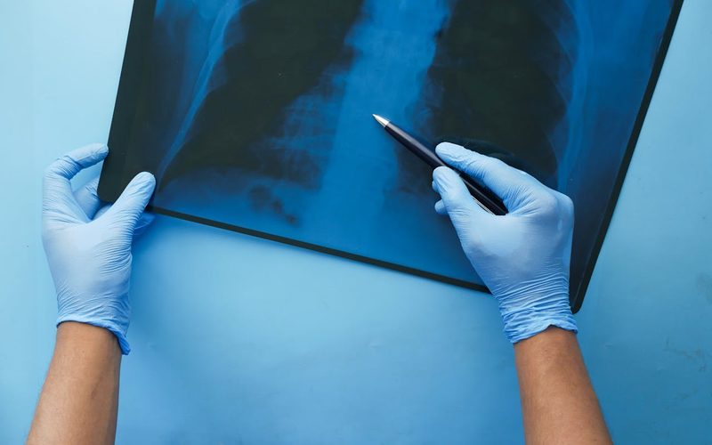 How Serious Is Fluid in the Lungs in Elderly? Warning Signs You Can't Ignore