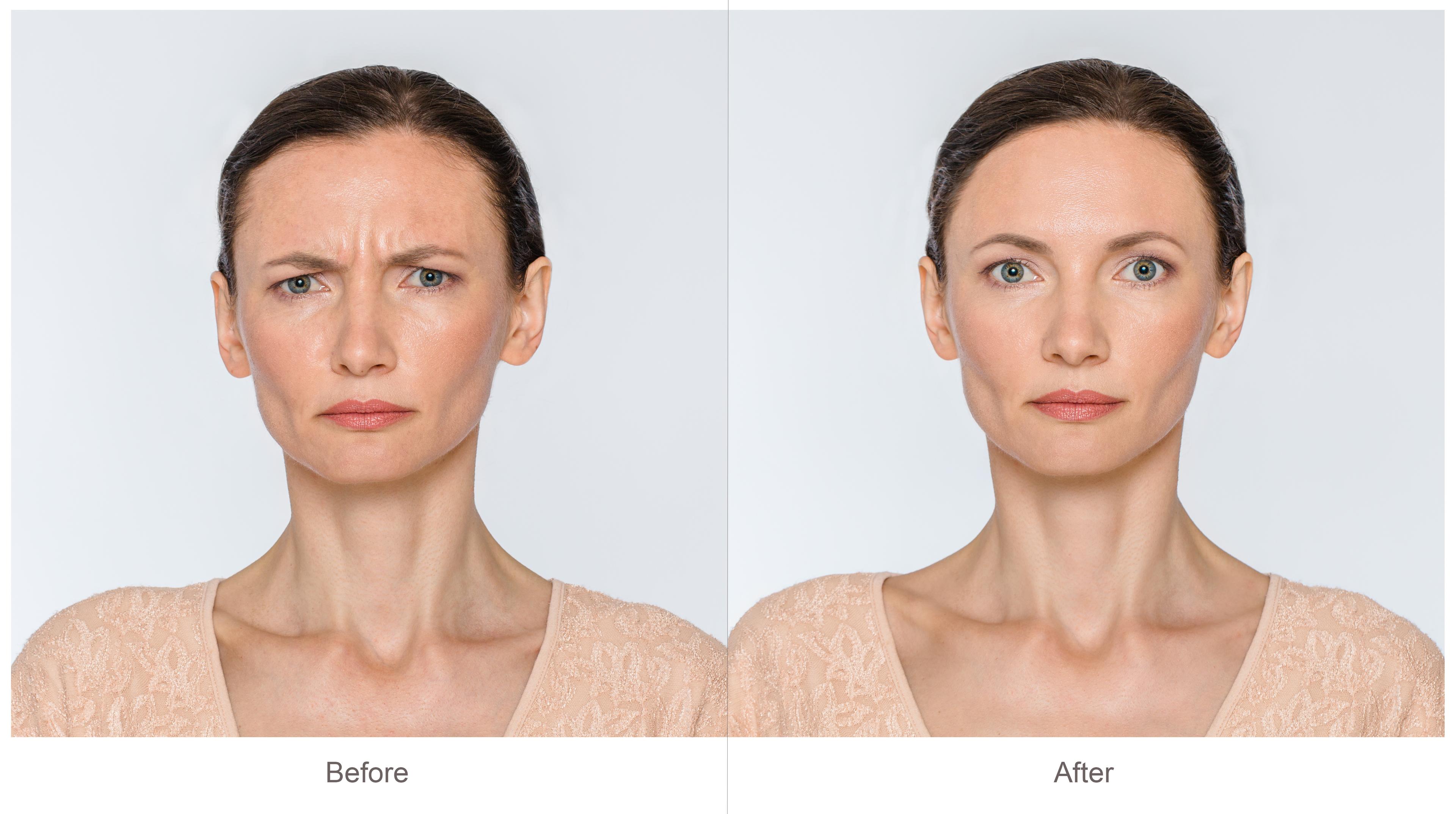 Botox Before And After | Glowday