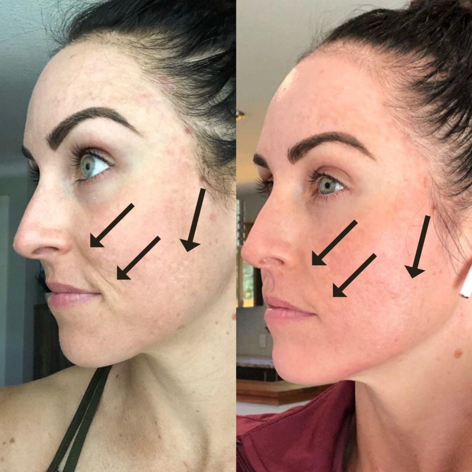 guide to microneedling Glowday