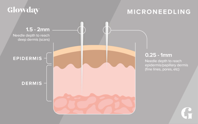 How microneedling works