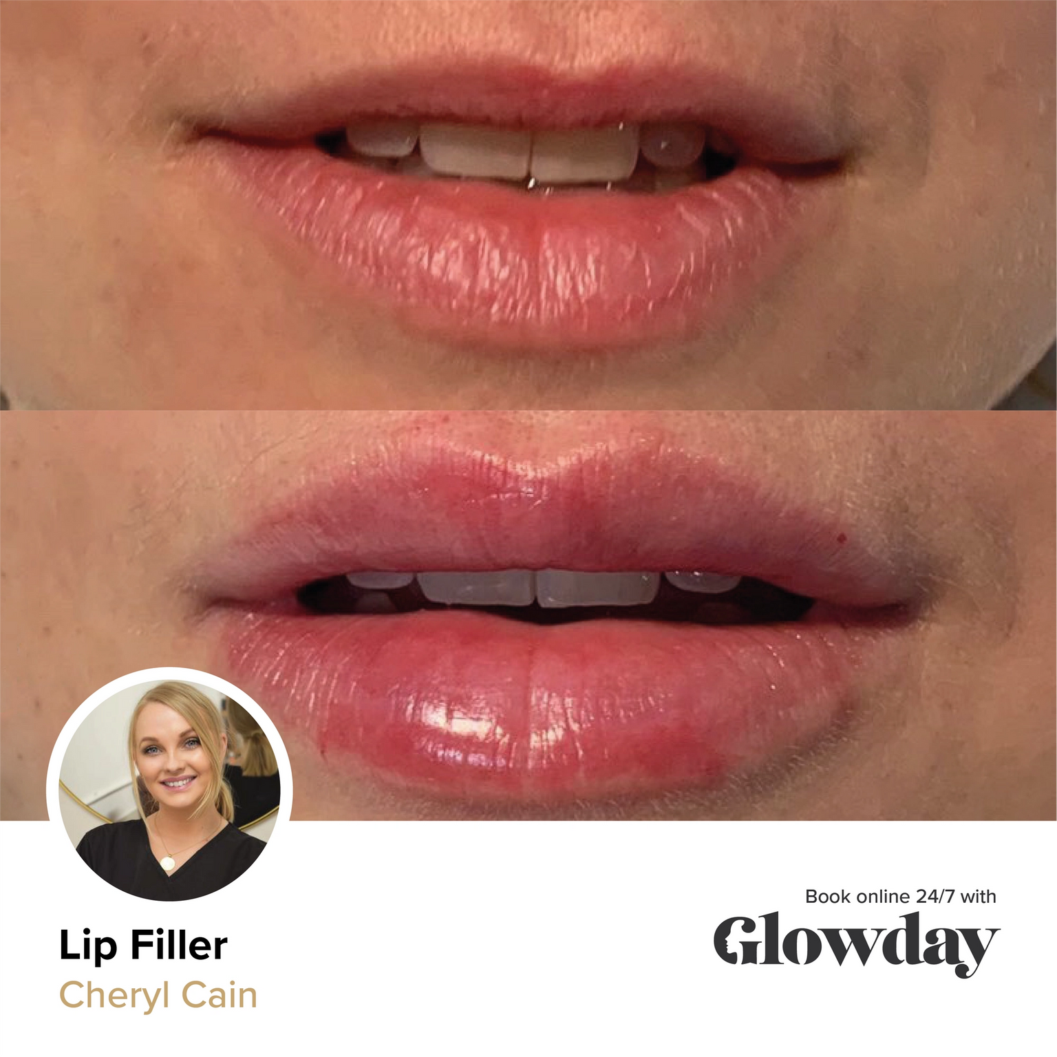 Juicy lip filler results - by Chery Cain