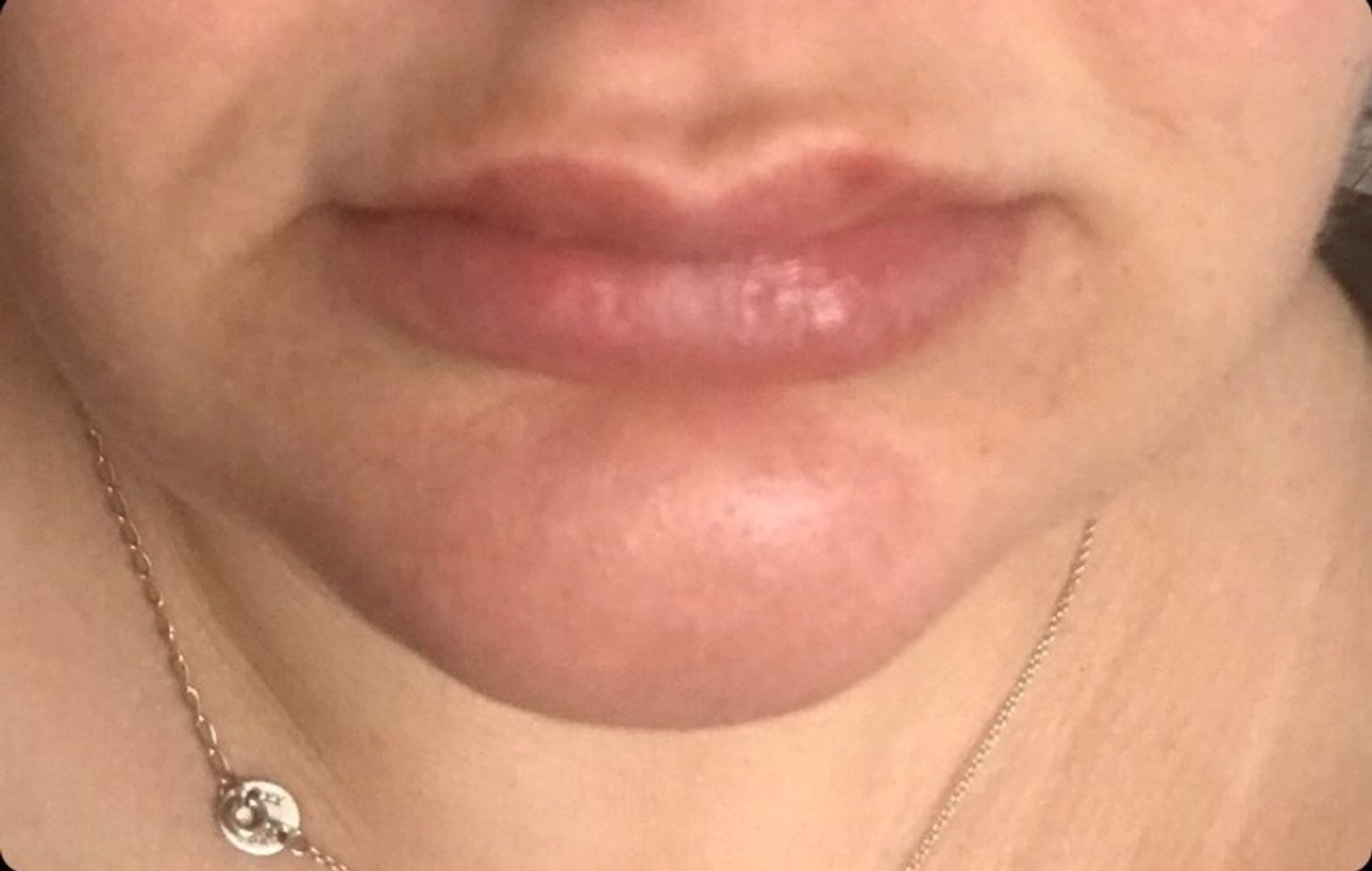 Her beautifully plump pout one week on