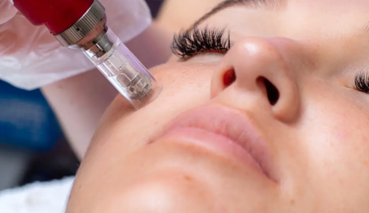 guide to microneedling Glowday