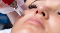banner for The Mini Guide To Microneedling