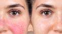 banner for What Is Rosacea, and How Do You Treat it?