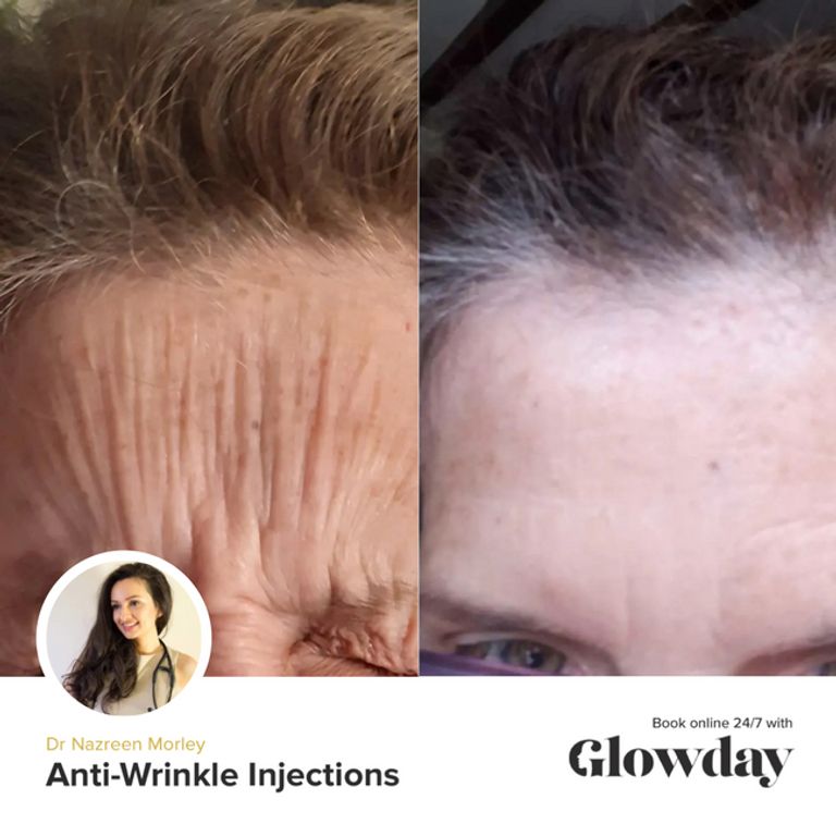 The truth about botox glowday