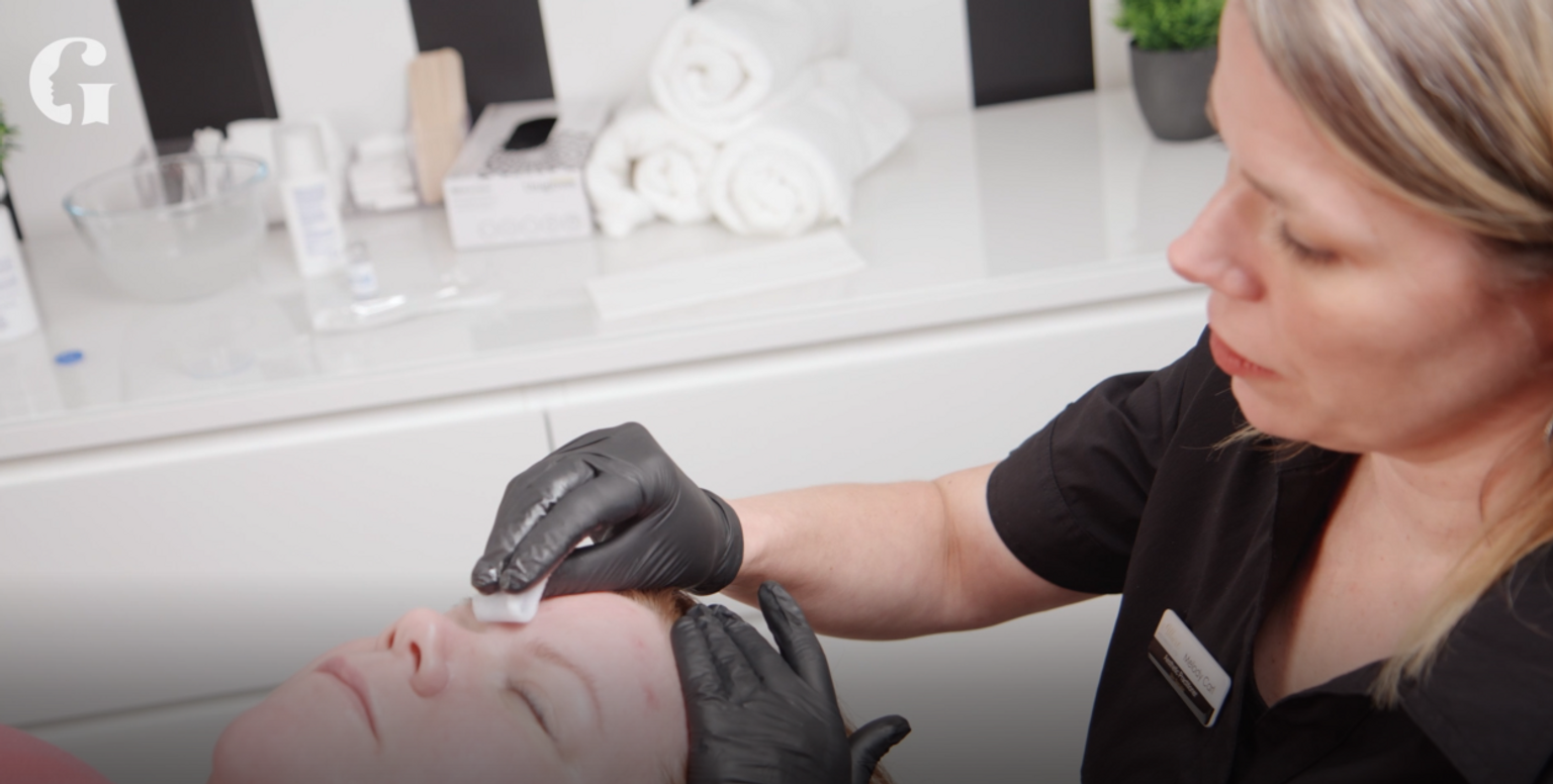 Jackie's first chemical peel experience