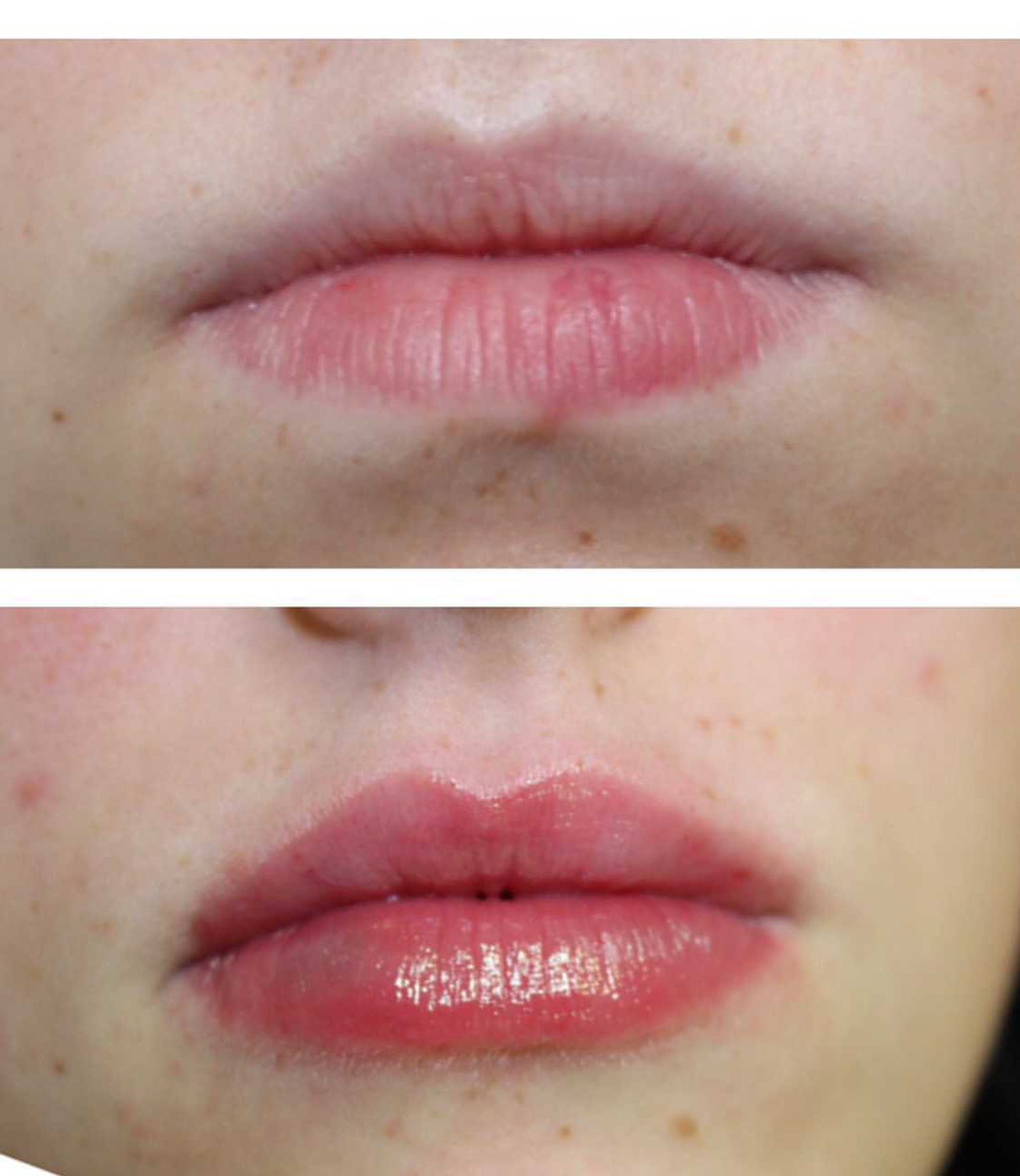 Gema Lorenzo - lip filler before and after - Glowday