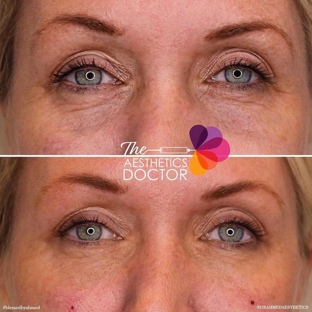 Tear trough filler before and after