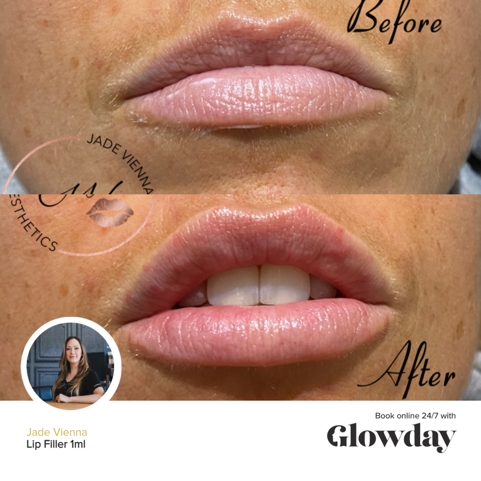 Jade Vienna - Lip Fillers Before and After - Glowday 