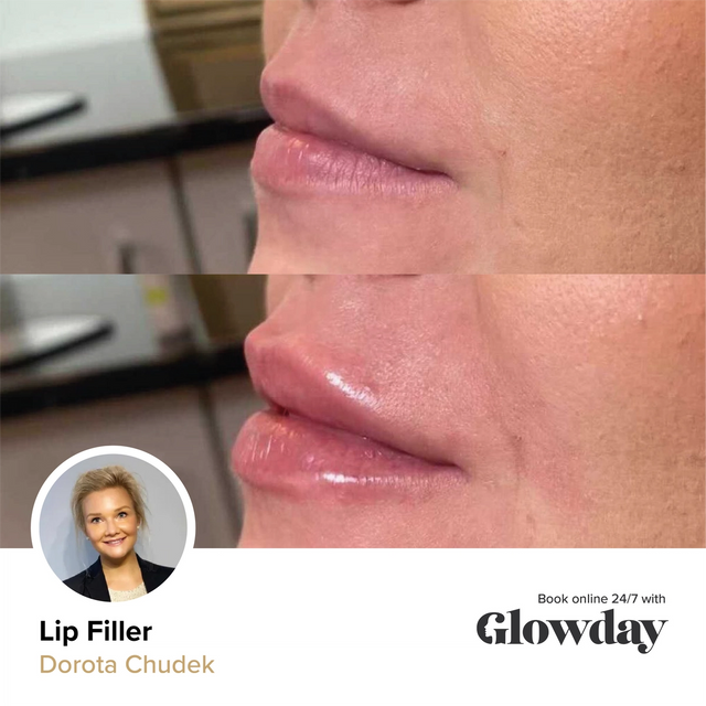 Lip filler before and after - by Dr Dorota Chudek