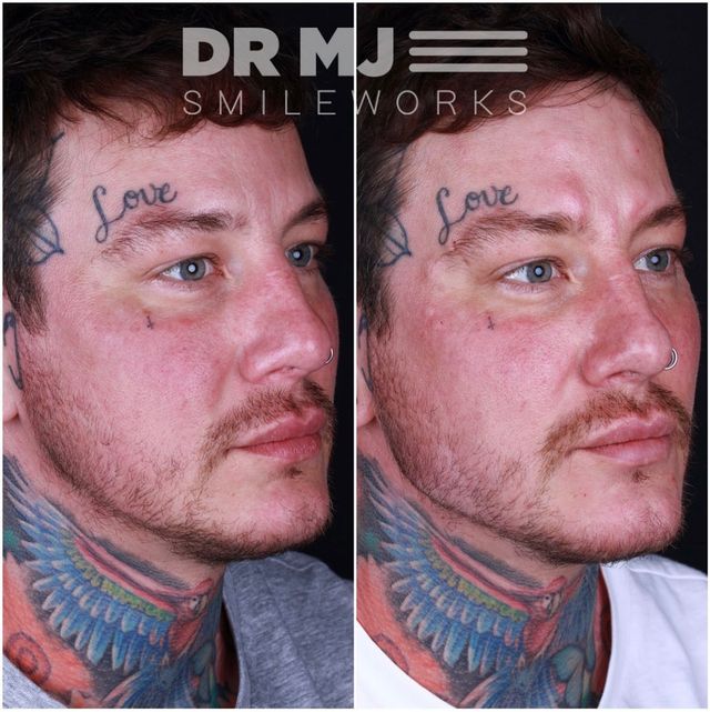 Jawline augmentation before and after - Dr MJ Rowland-Warmann - Glowday