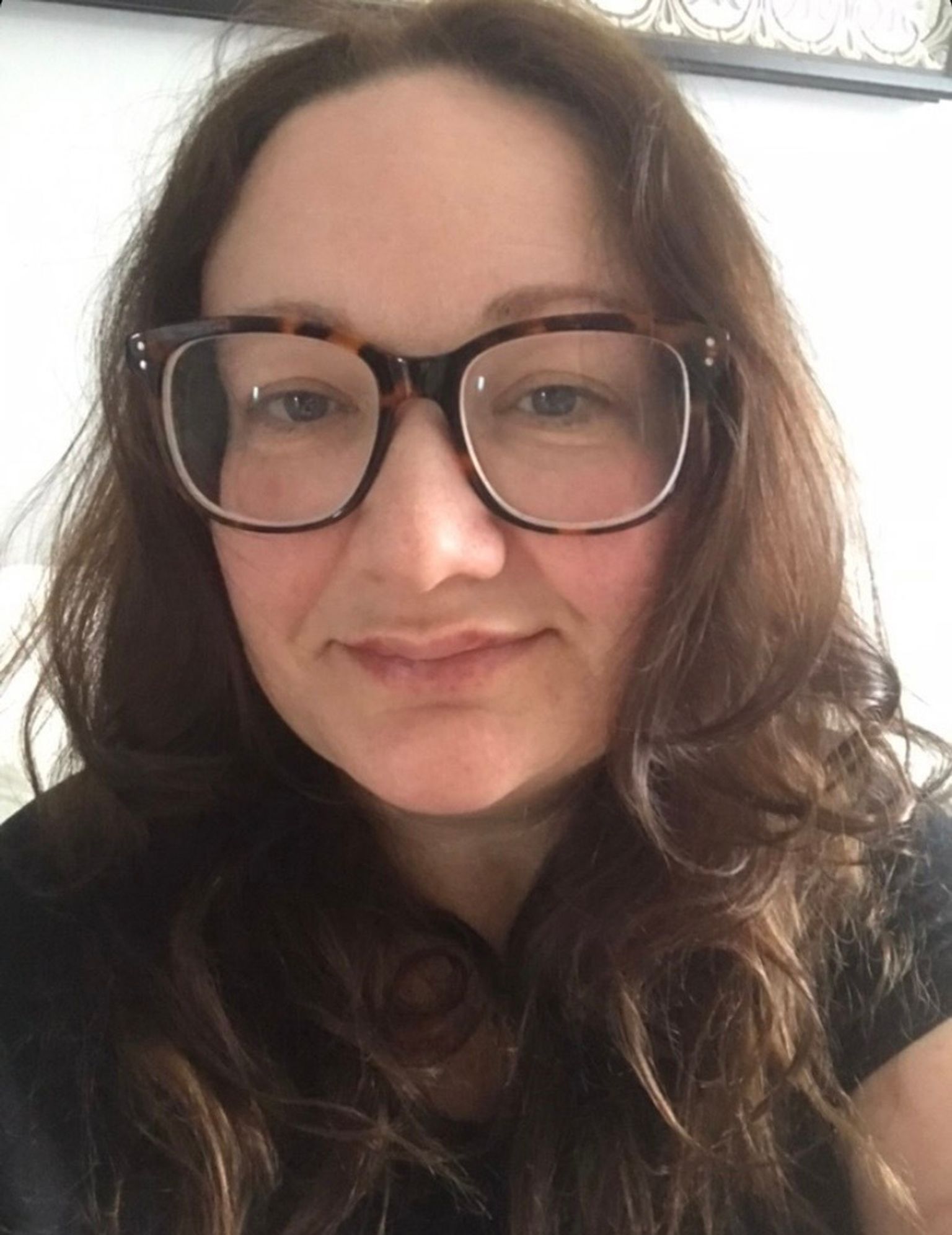 Hannah after her first lip filler treatment
