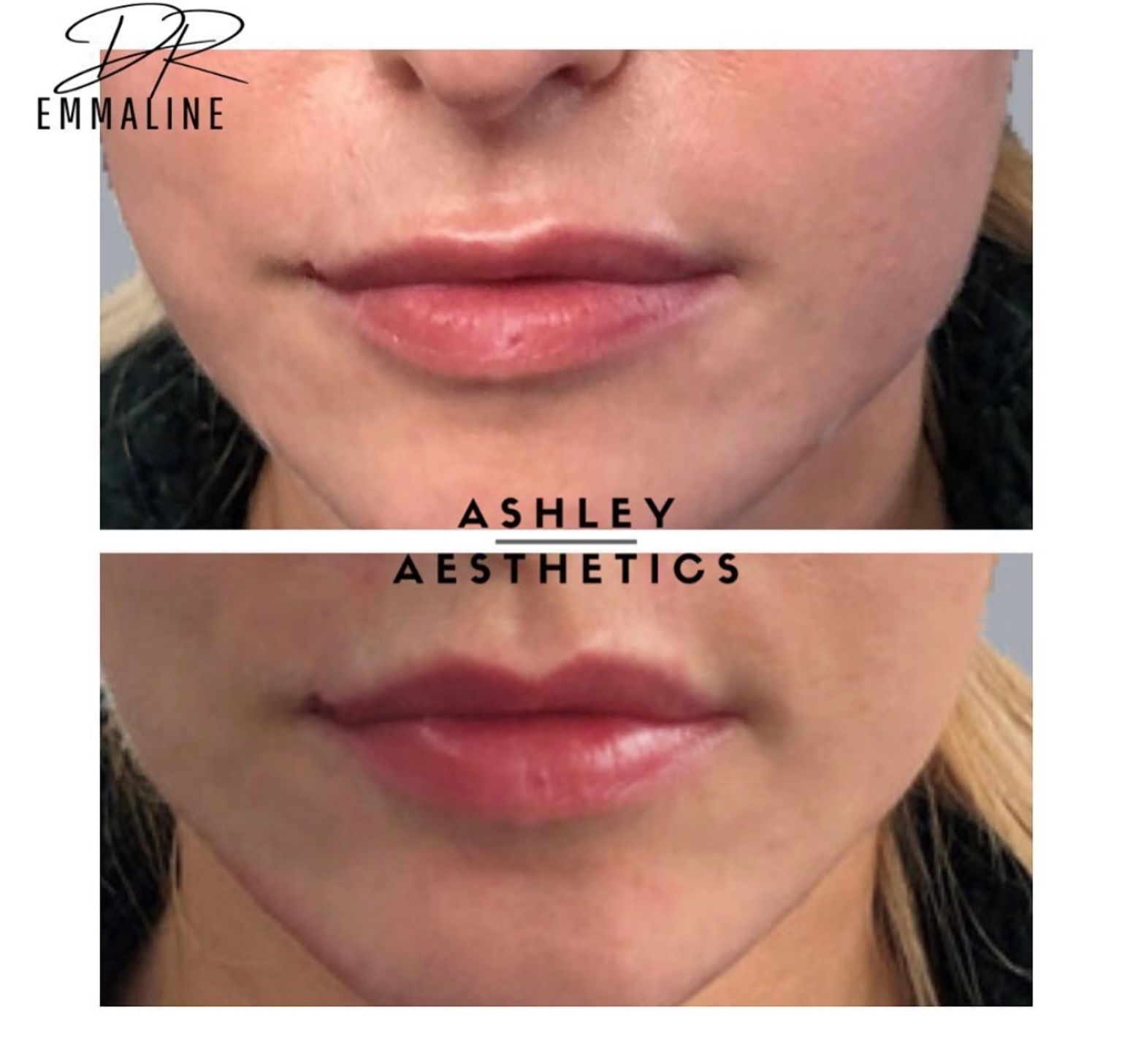 Dr Emmaline Ashley - lip filler before and after - Glowday