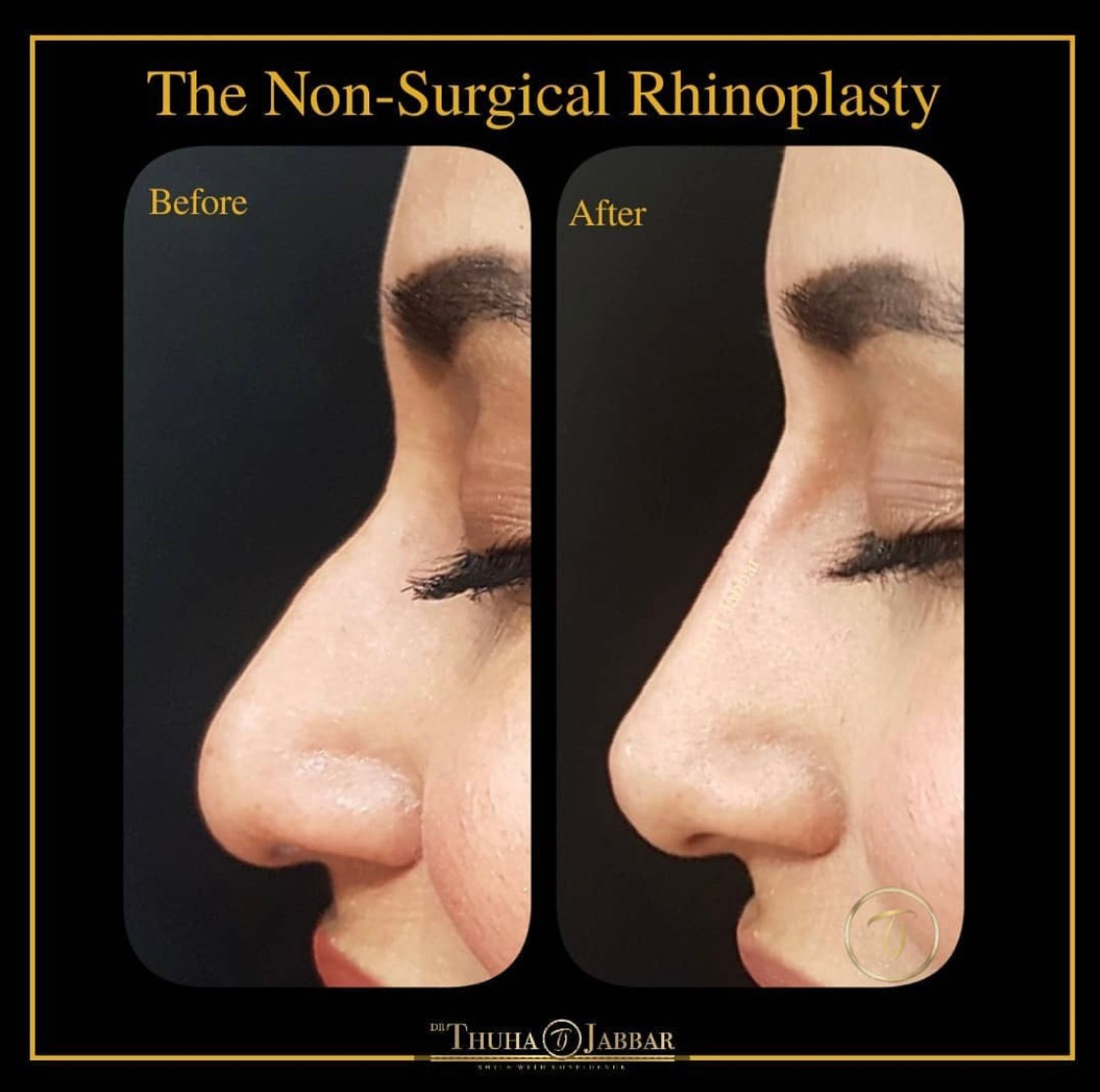 Non-surgical nose job before and after - By Dr Jabbar