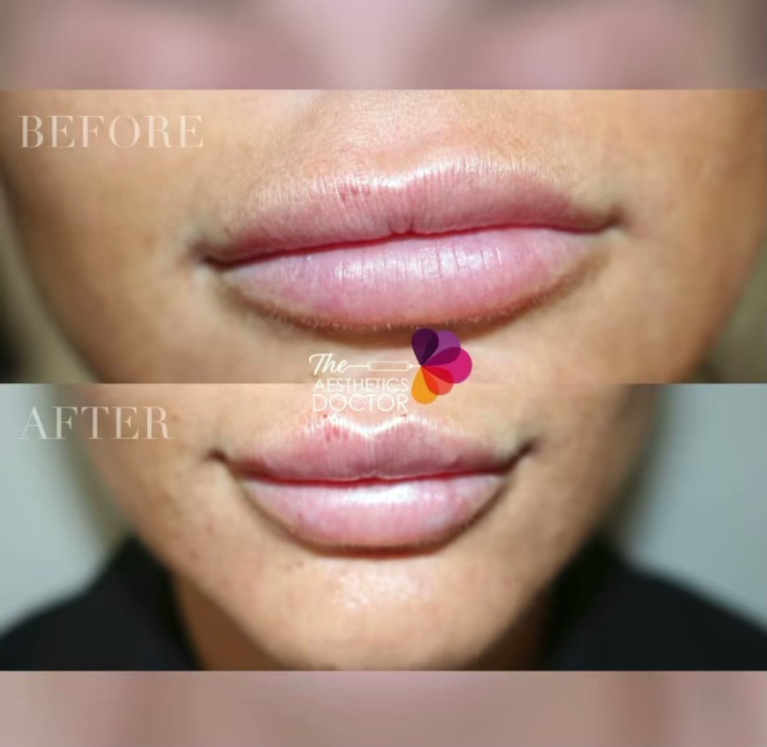 Dr Ahmed - lip filler before and after - Glowday