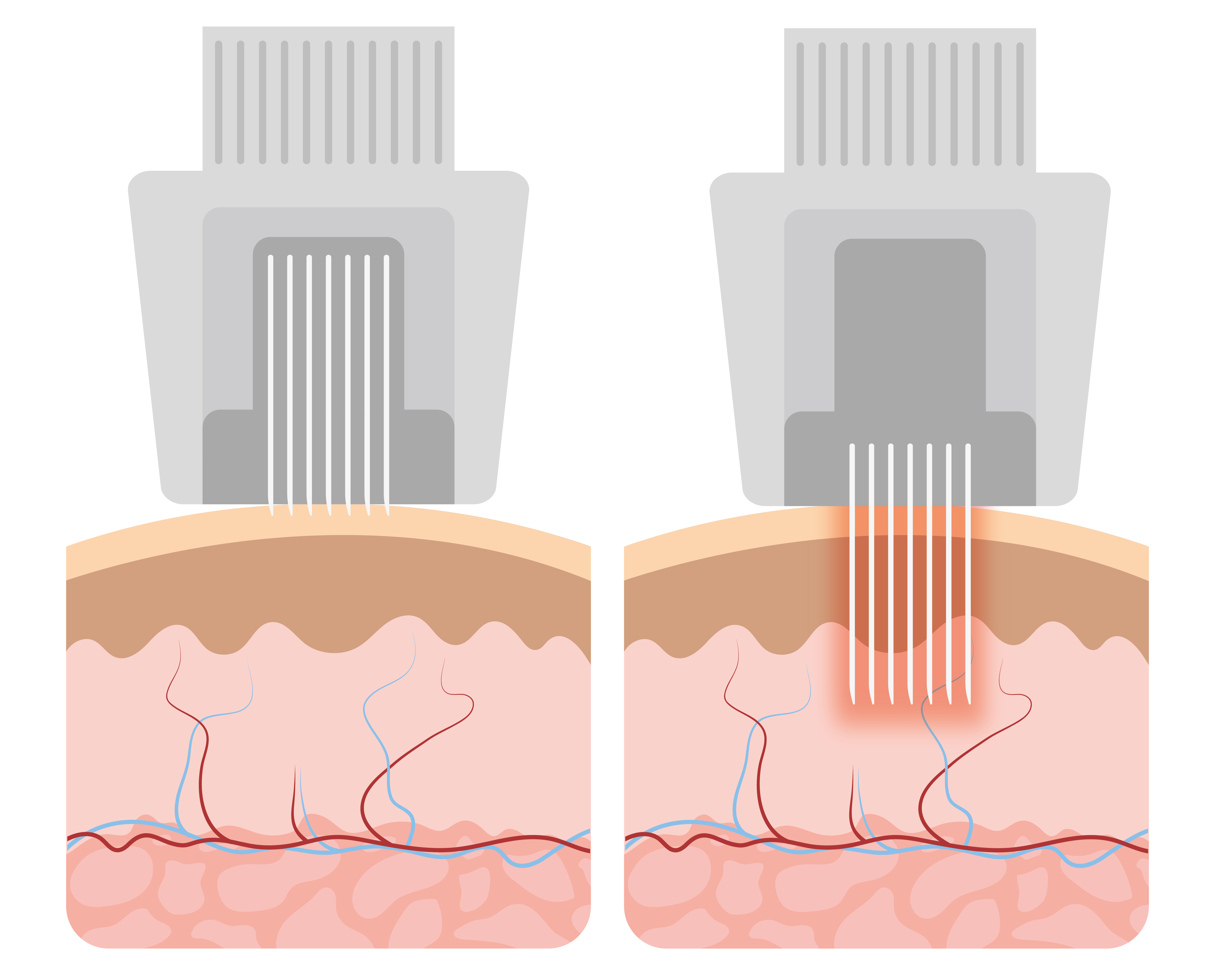 Radiofrequency Microneedling | Glowday